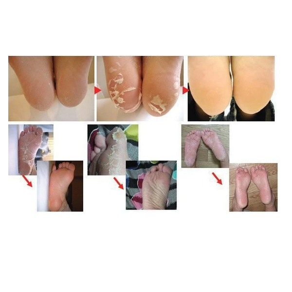 Chaussettes Exfoliantes Lirene - Peeling Et Soin Régénérant Pour Les Pieds - 1 Paire - Neuf